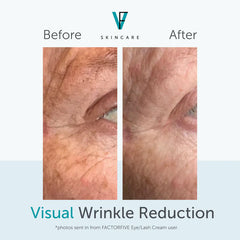 Before and after visual of wrinkle reduction on eye area with 'FactorFIVE Skincare' branding.