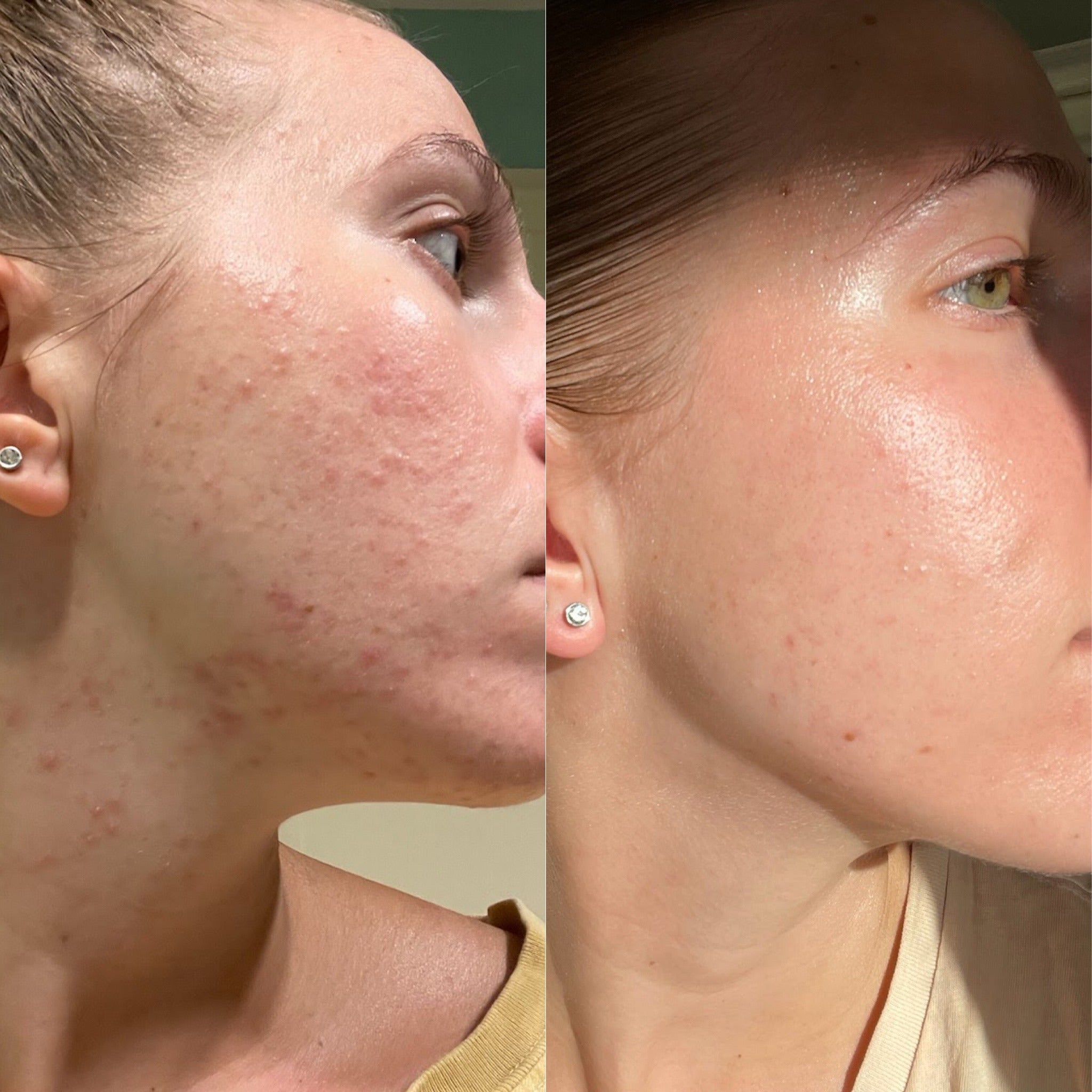 Before and after comparison of a person's face with visible skin texture changes.