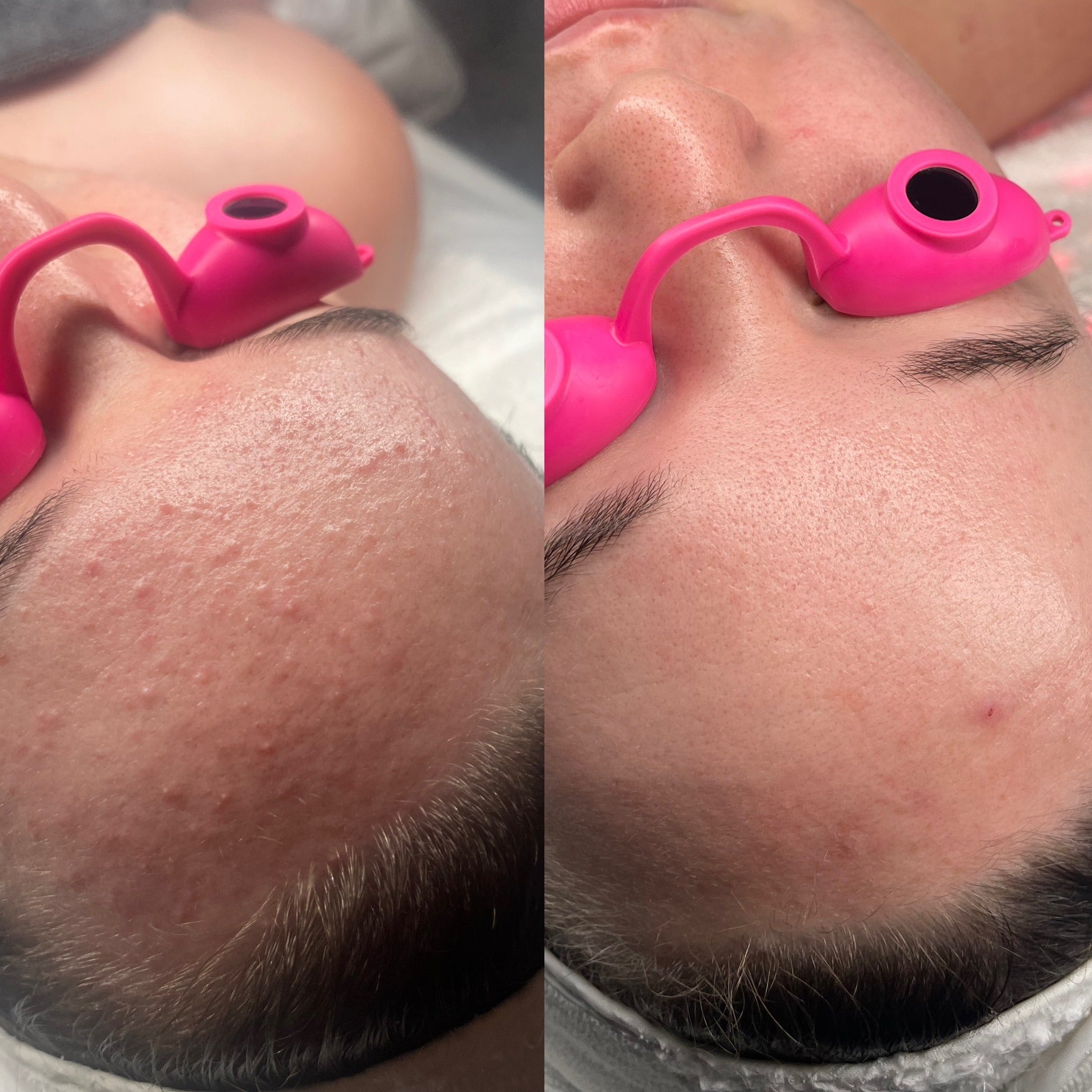 Before and after comparison of a person using a pink facial tool on their face.