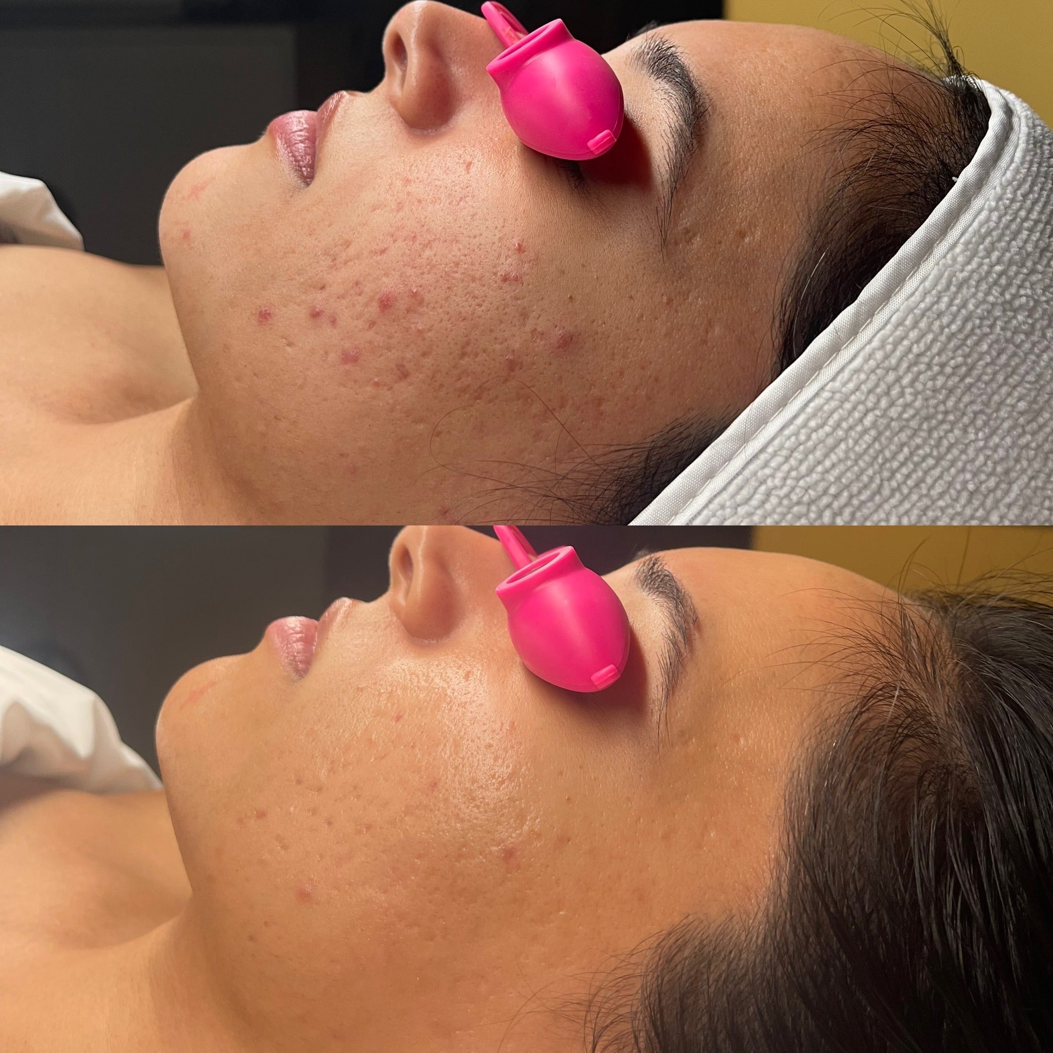 Before and after comparison of a person using a pink facial roller on their face.