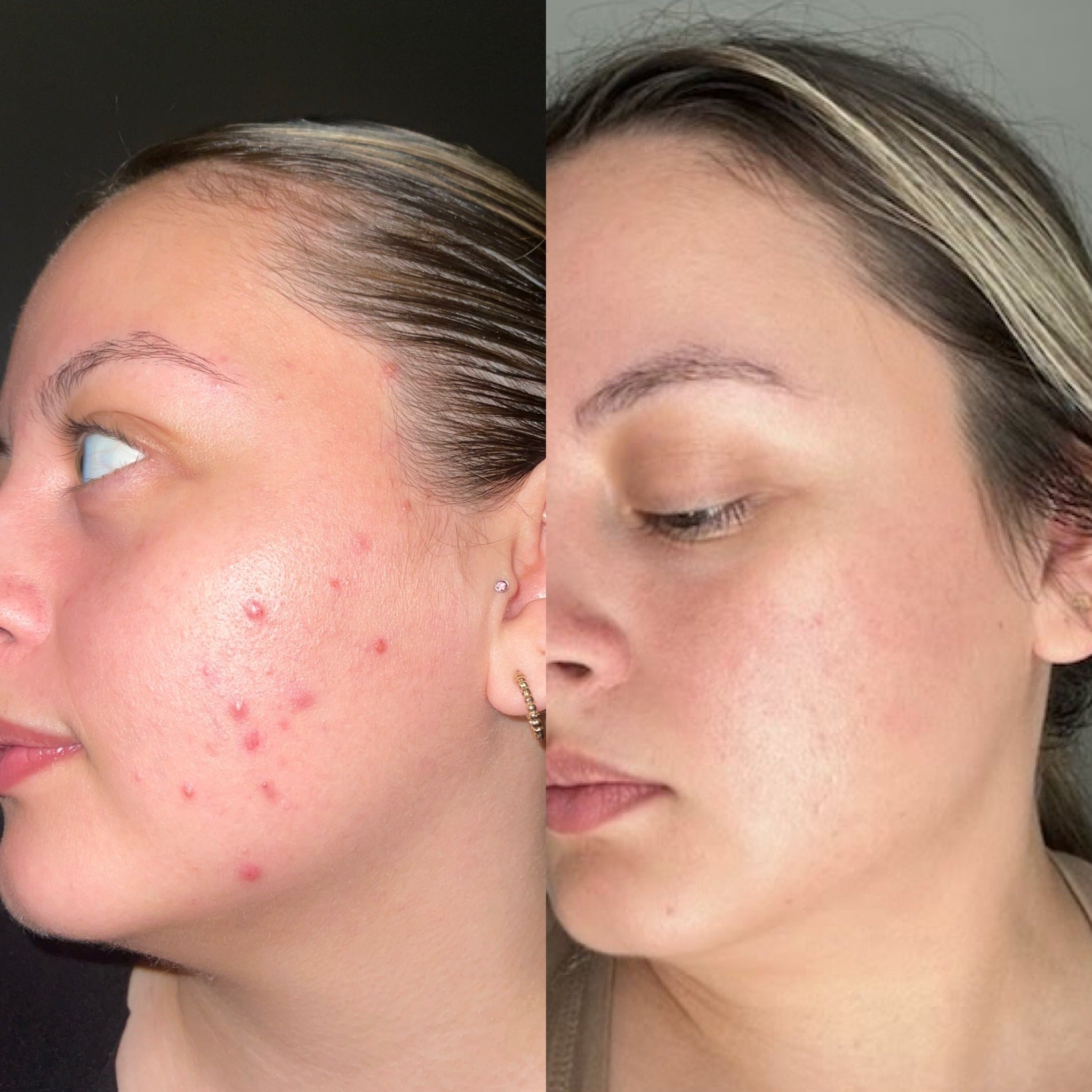 Before and after comparison of a woman's face with acne on the left and clear skin on the right.