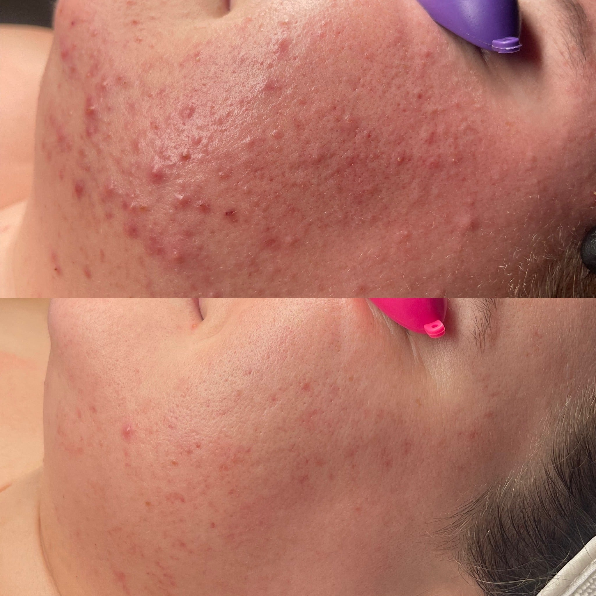 Before and after comparison of acne-prone skin treatment on a person's face.